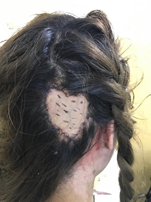 Cô gái 16 tuổi bị bong 1 mảng lớn da đầu sau khi đi uốn tóc